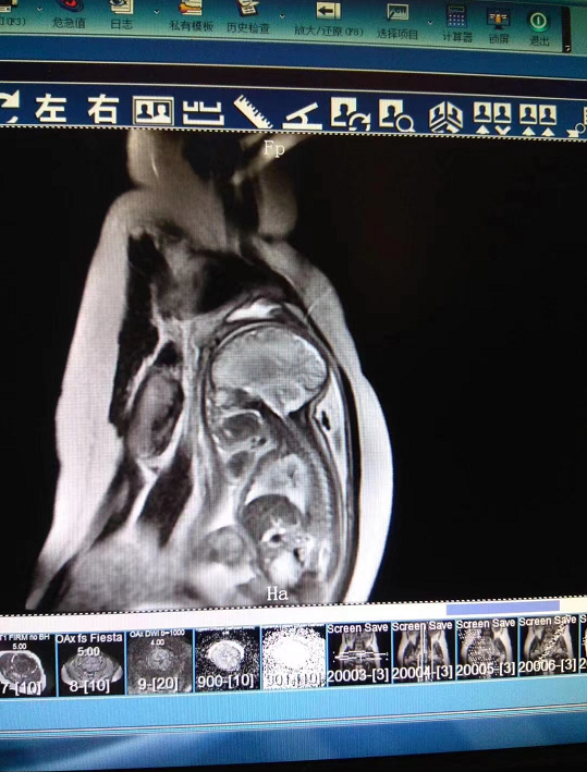 周口市儿童医院核磁共振室特色检查之--胎头MRI检查：