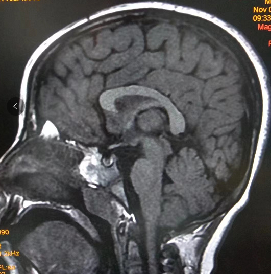 周口市儿童医院核磁共振特色检查之——脑垂体生长发育检查：