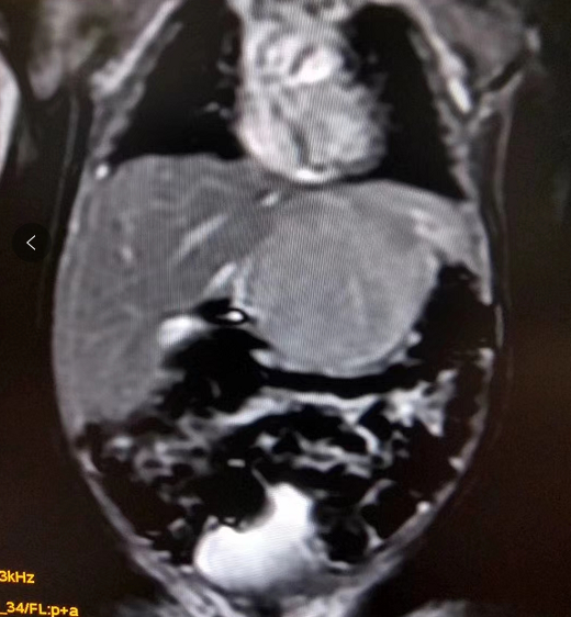 周口市儿童医院核磁共振室特色检查之--新生儿肝脏MRI检查（肝母细胞瘤）：