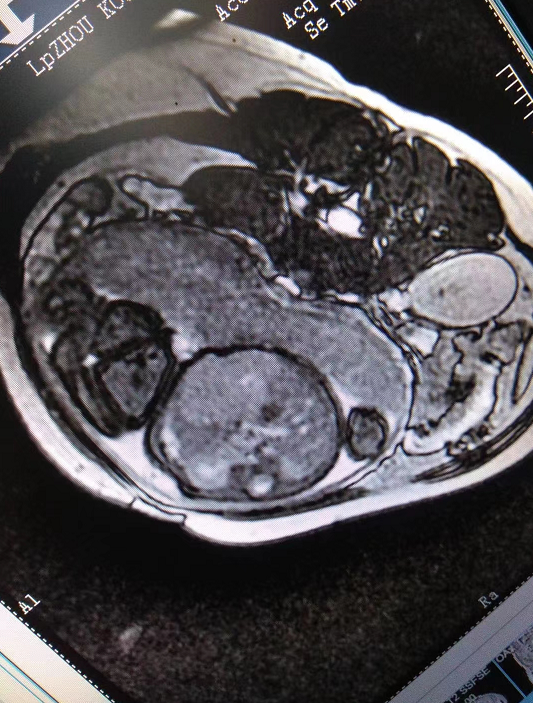 周口市儿童医院核磁共振室特色检查之--胎儿肝脏MRI检查（血管内皮细胞瘤）：