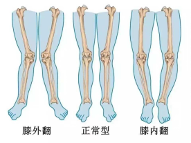 “O”型腿矫正方法